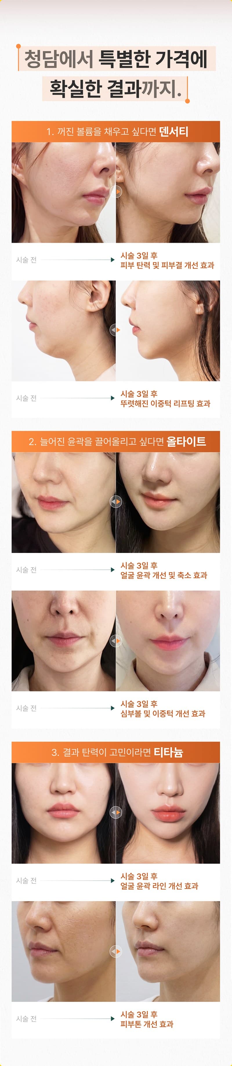 덴서티, 올타이트, 티타늄 리프팅 3종 비교 안내
